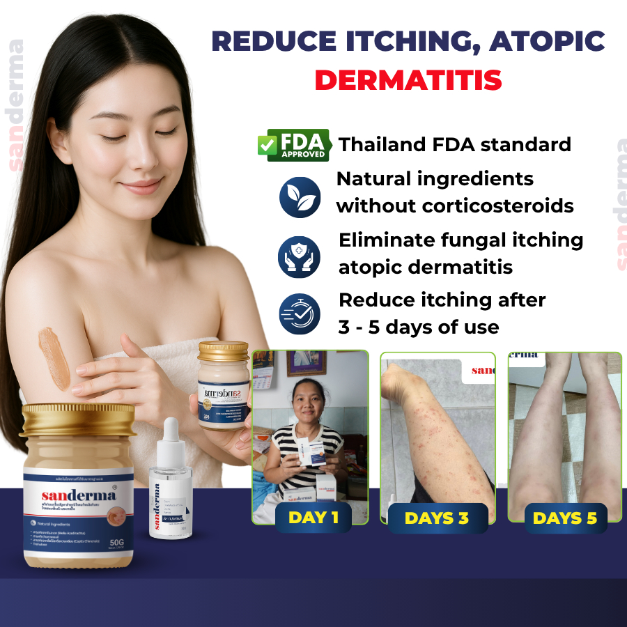 SANDERMA Skin Cream Helps Reduce Dermatitis, Diaper Rash, Itching ...