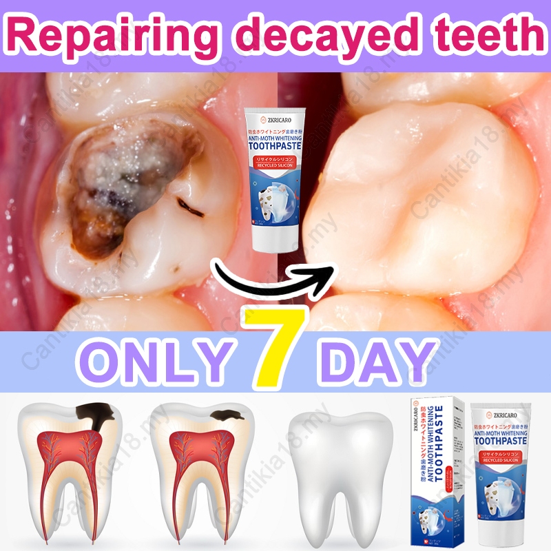 Anti-caries toothpaste,tooth repair toothpaste, Fluoride toothpaste ...