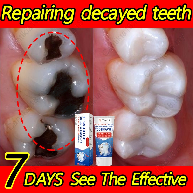 Anti-caries toothpaste,tooth repair toothpaste, Fluoride toothpaste ...