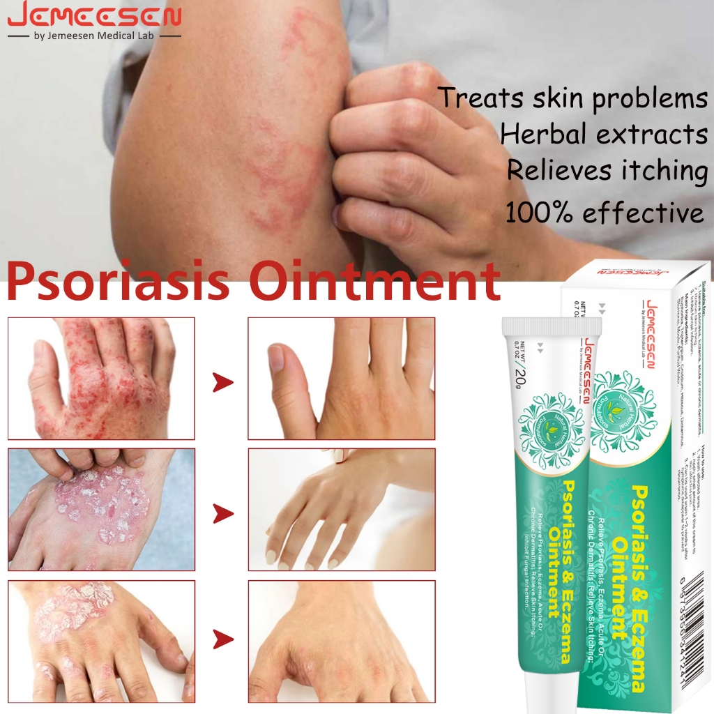 Jemeesen 20g Eczema Cream Effective treatment for eczema, psoriasis ...