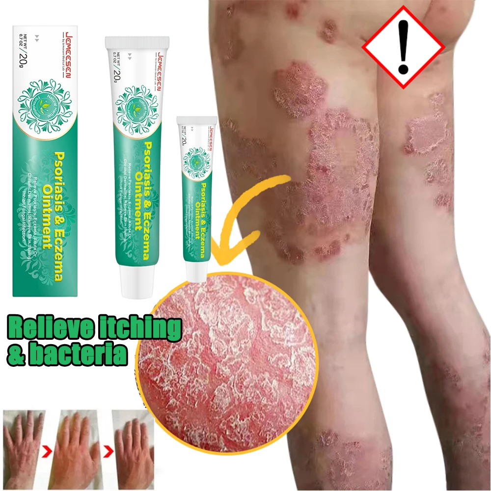 5 days Treat eczema psoriasis cream dermatitis Antibacterial ointment ...