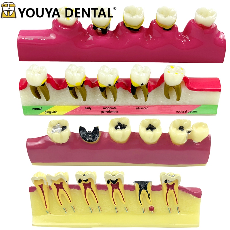Dental Model Teeth Periodontal Disease Model Tooth Dental Teaching ...