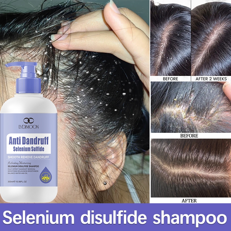 Selenium Sulfide Anti-Dandruff Shampoo for Oil Control and Scalp ...