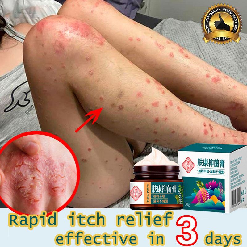 Eczema Cream Antibacterial anti itch cream anti itch dermatitis rash ...