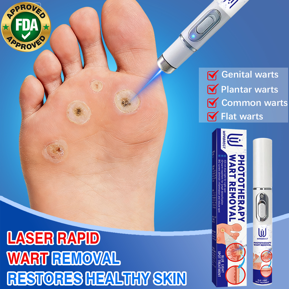 laser-wart-removal-complete-removal-of-flat-warts-filiform-warts-and