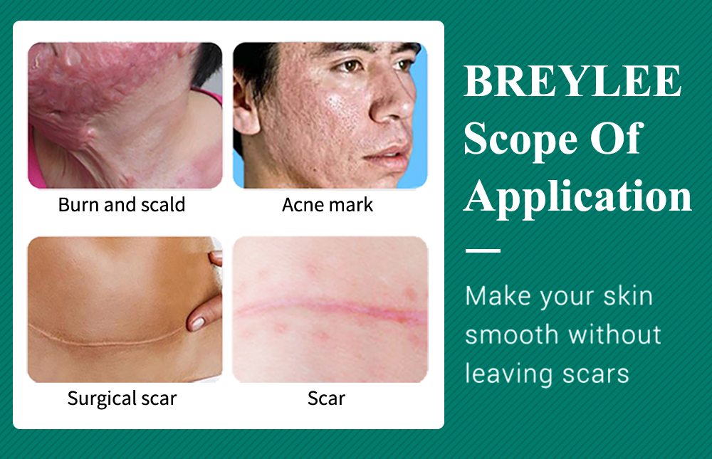 BREYLEE Acne Scar Removal Cream Fades Acne Marks Fade Scar Melanin ...