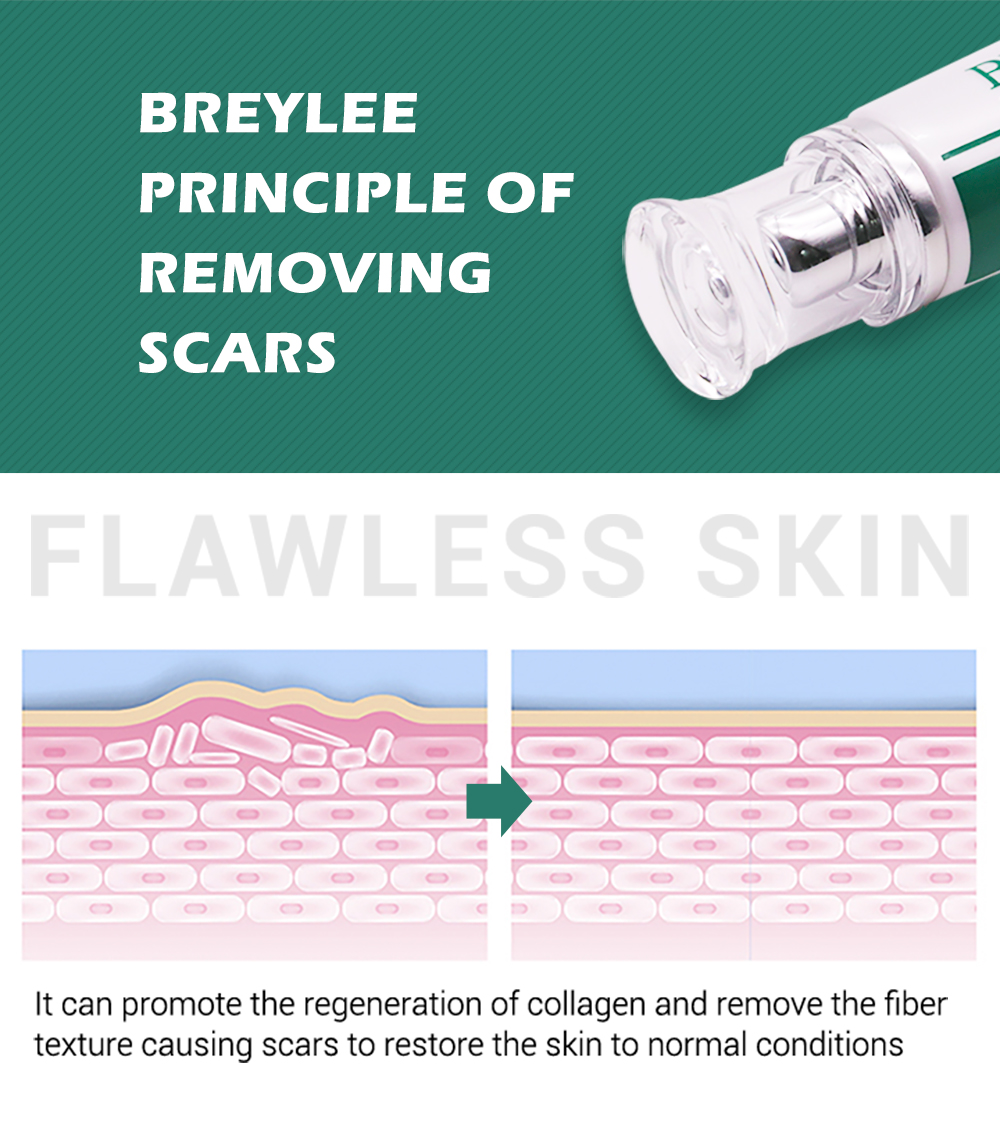 BREYLEE Acne Scar Removal Cream Fades Acne Marks Fade Scar Melanin ...