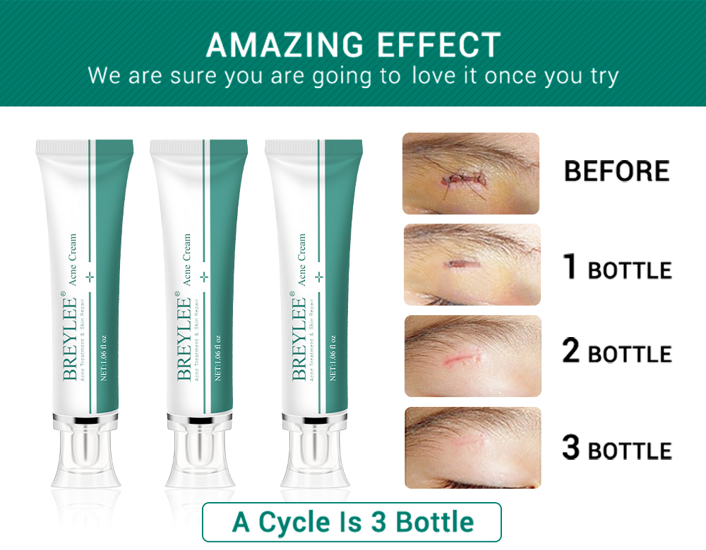 BREYLEE Acne Scar Removal Cream Fades Acne Marks Fade Scar Melanin ...