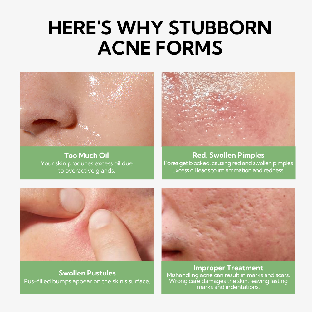 LANBENA Acne Essence Salicylic Acid Anti-acne Serum Lighten Acne Scars ...