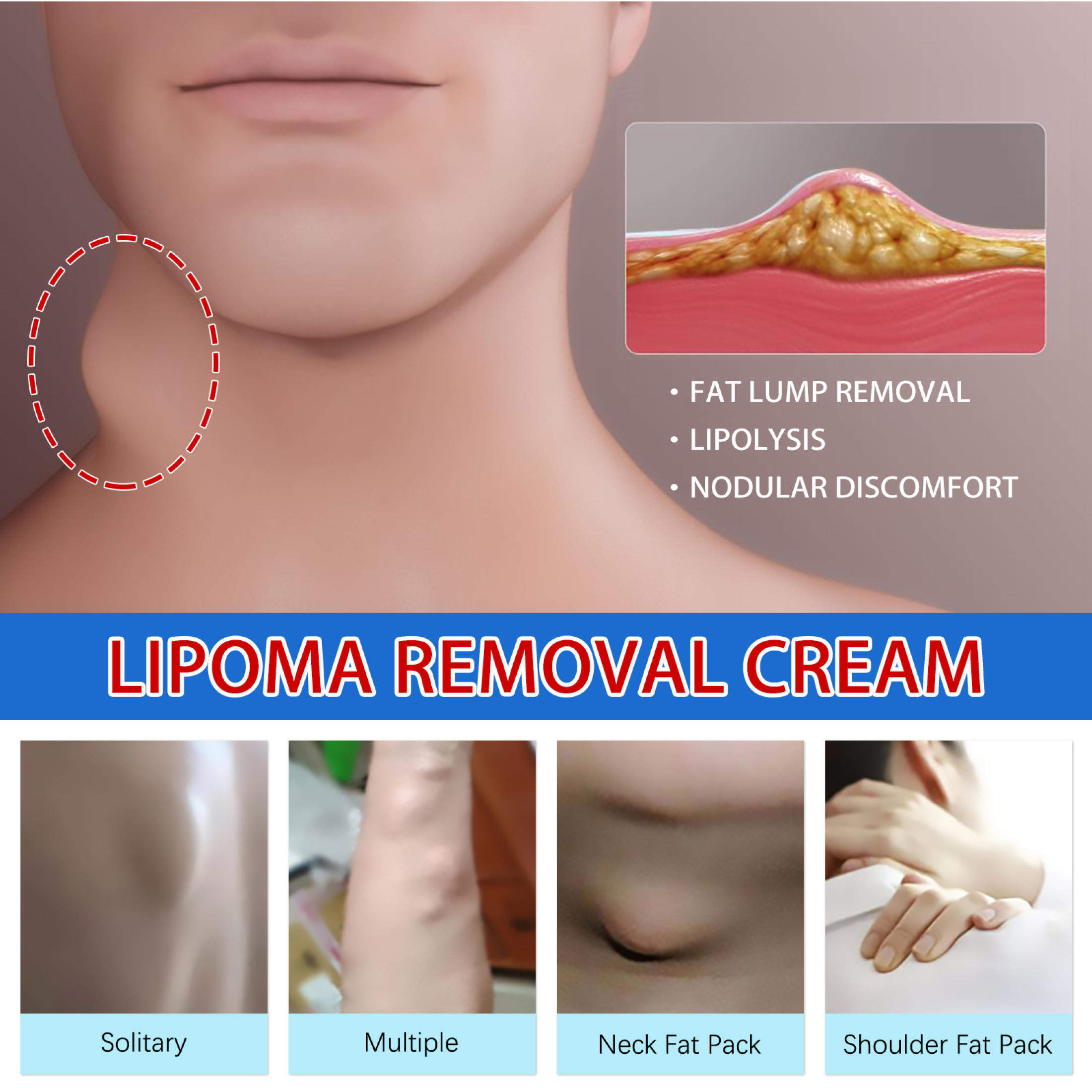Lipoma Cream Ointment Fat Granule Care External Swelling Cellulite ...