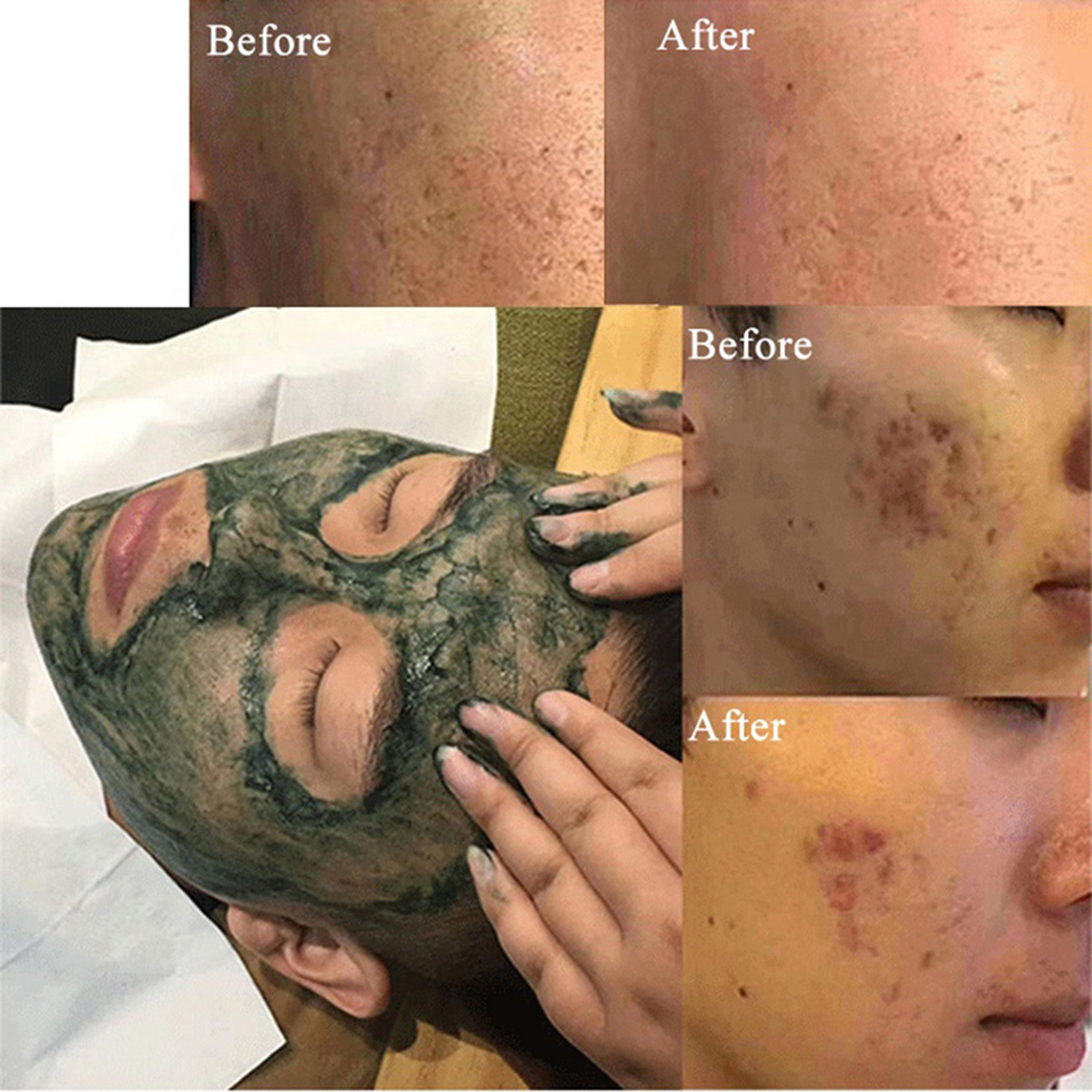 Sponge Micro-needle Freeze-dried Powder Repair Acne Clean Hair ...