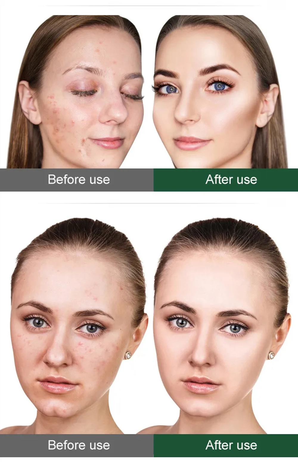 Sponge Micro-needle Freeze-dried Powder Repair Acne Clean Hair ...