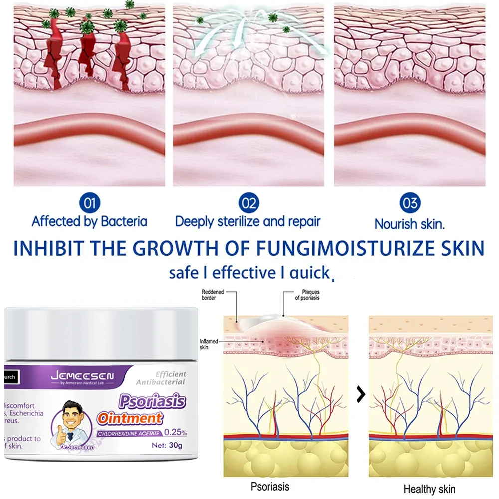Jemeesen Psoriasis Relief Cream Soothe Itchy Skin Reduce Redness ...
