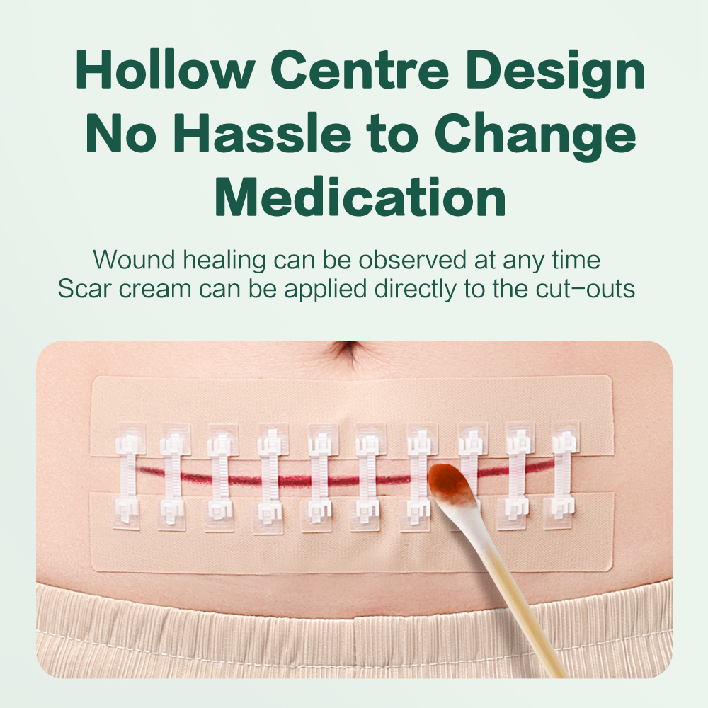 Cofoe Wound Skin Tension Reducer Bandage Zipper Bandaid Suturefree