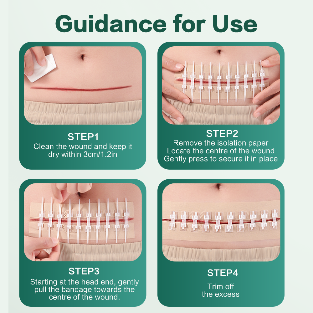 Cofoe Wound Skin Tension Reducer Bandage Zipper Bandaid Suturefree