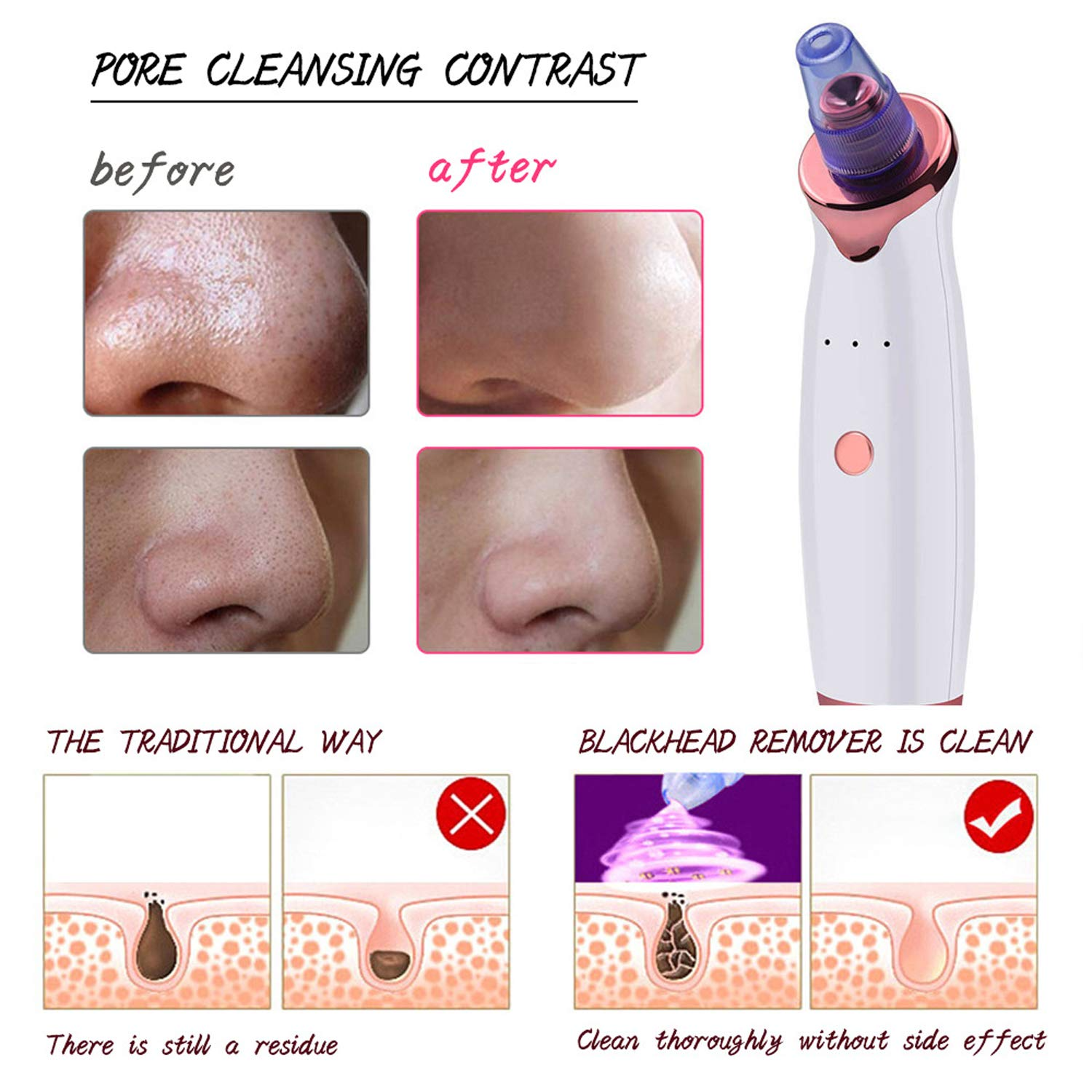 5IN1 Electric Blackhead Remover Whitehead Blackhead Vacuum Suction Pore ...