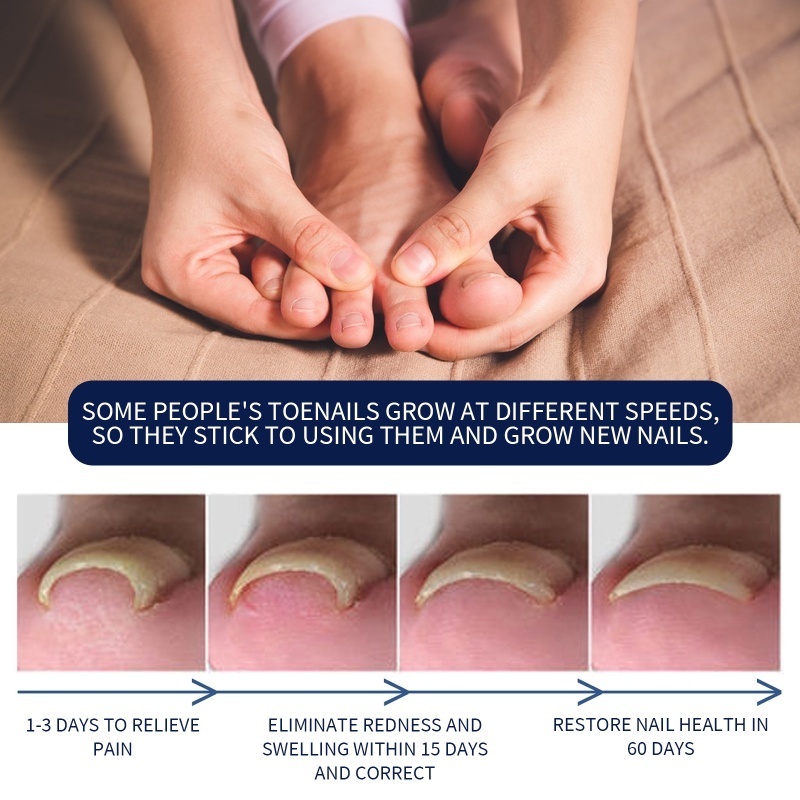 Toenail Repair Serum Rotten ingrown toenail treatment ubat kuku rosak ...
