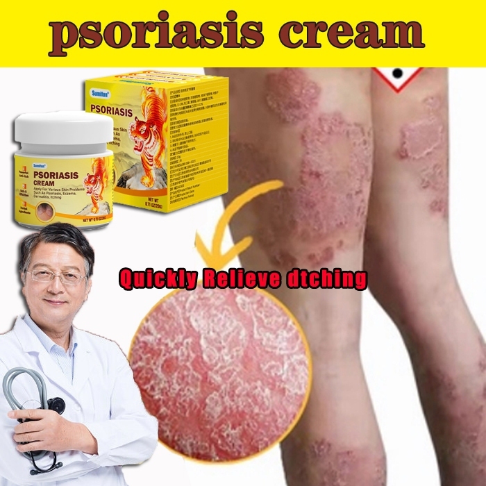 Sumifun 20g antifungal cream psoriasis cream Natural Herbal Psoriasis ...