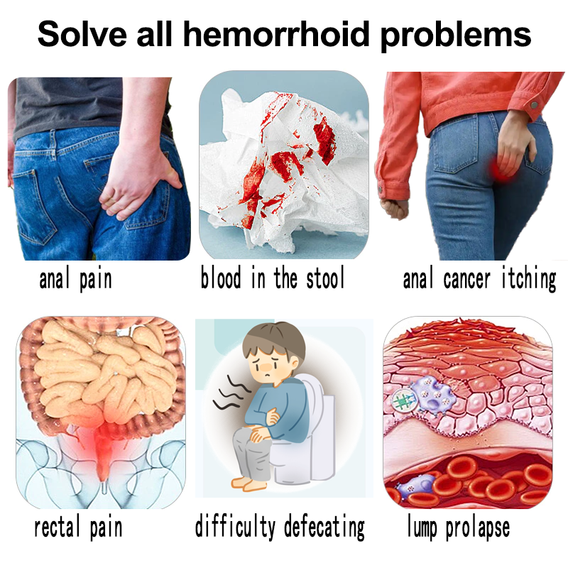 Hemorrhoid cream 20g Anal fissure.meatball.rectal bleeding.internal ...