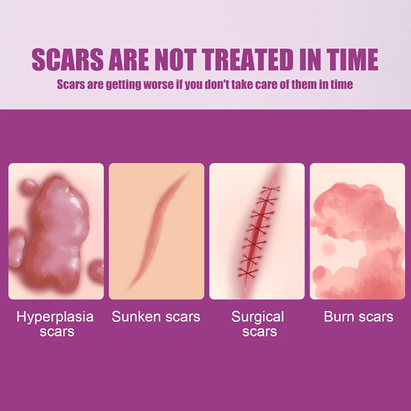 【Ready Stock】Upgraded 50g Scar Smoothing Repair Cream Repairs Wounded ...