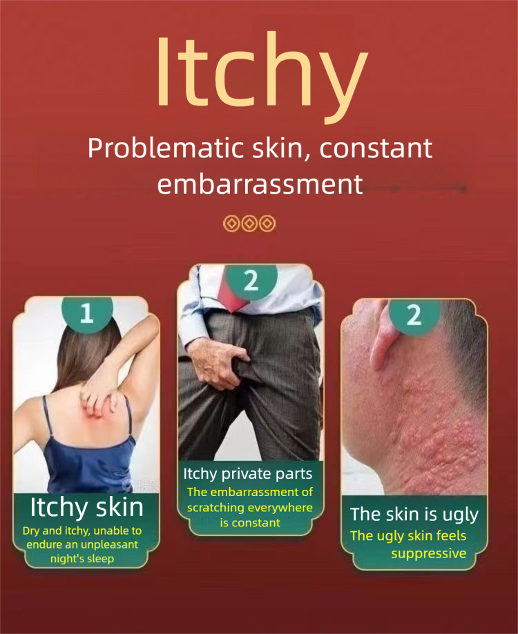 Herbs Cream Anti-itch Crack (55g) Nettle Rash Cream Wind Ball Anti-itch ...