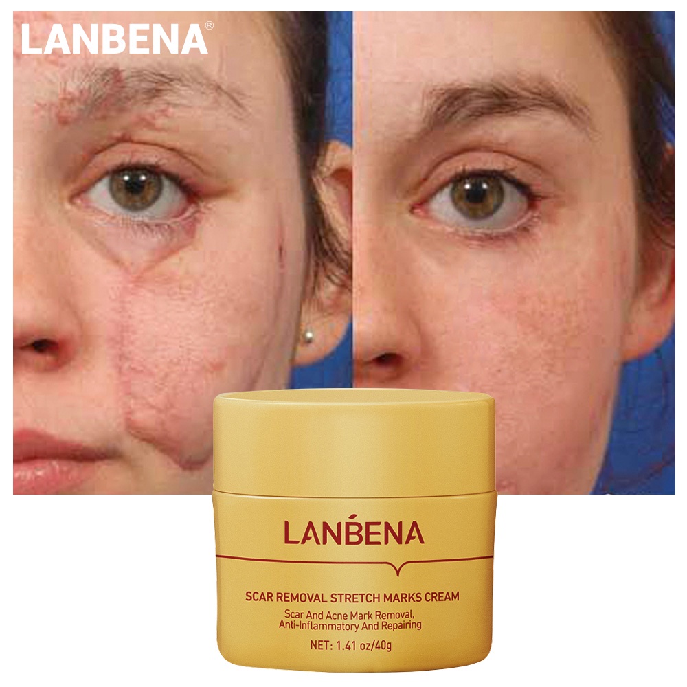 LANBENA Scar Removal Cream Repair Stretch Mark Blackhead Acne Spots