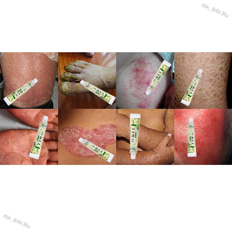 rbk_84k3tu Psoriasis Eczema Ointment Dermatitis Vitiligo Skin Rash ...