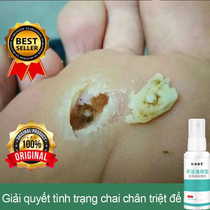 Skin tags Remove Warts Removes Warts, Removes Warts, Removes Calluses, And Feet, Removes Warts