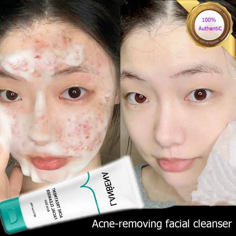 Antimite Facial Cleanser Acne Essence Whitening Fade Scars Skin Care
