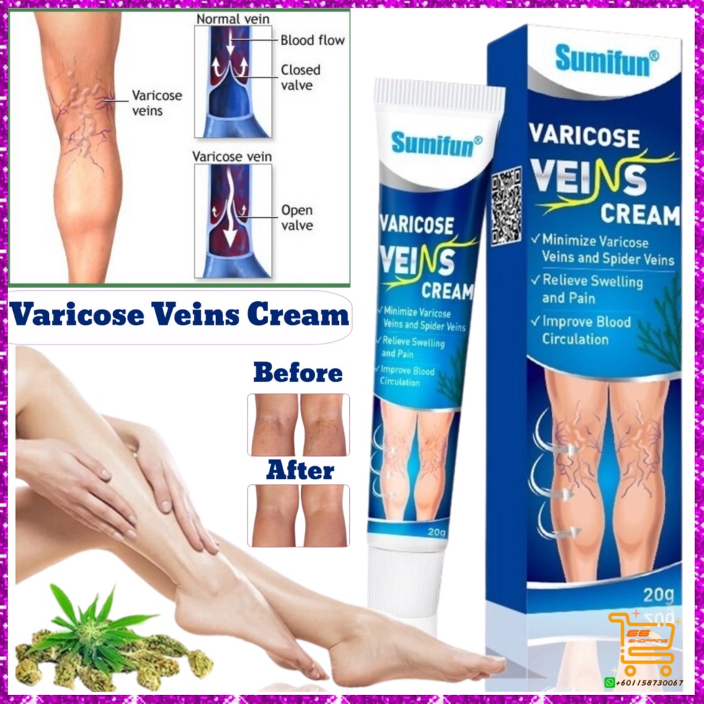 Varicose Veins Cream Sumifun(Phlebitis Varicosity Angiitis /Spider Leg