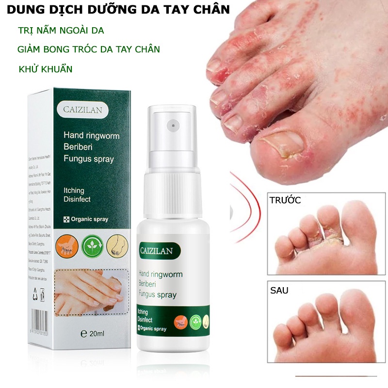 Herbal Hand Ringworm Beriberi Fungus Spray Powerful Itchy Foot ...
