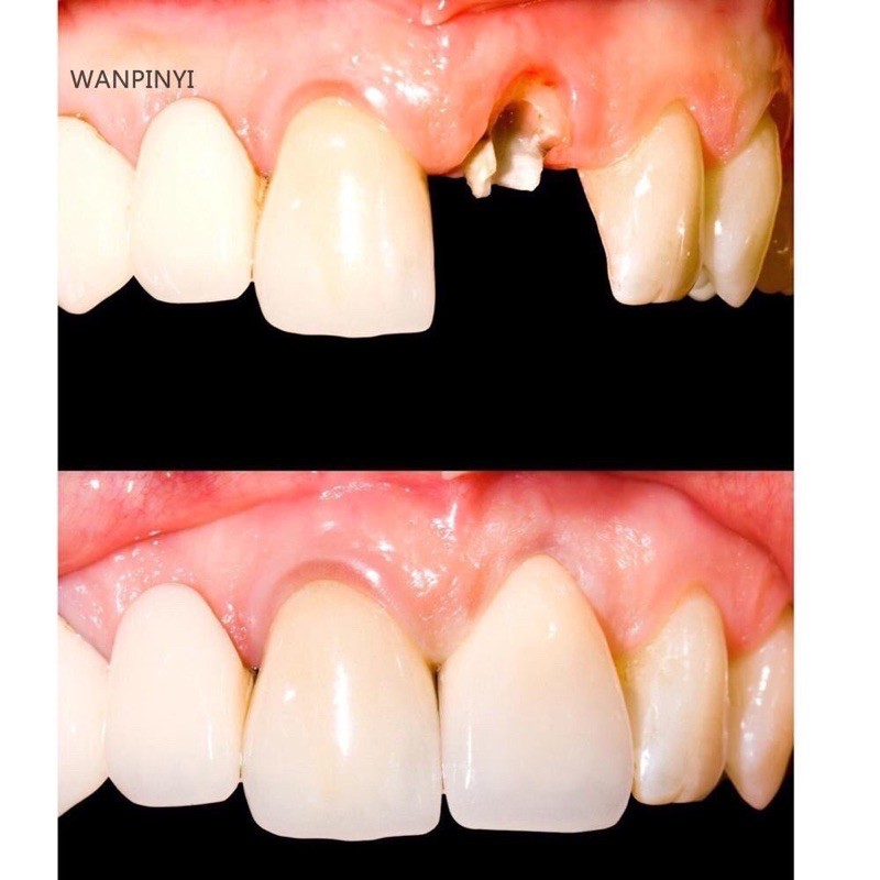 Smile temporary tooth kit gigi palsu siap dibentuk ketat tak mudah ...