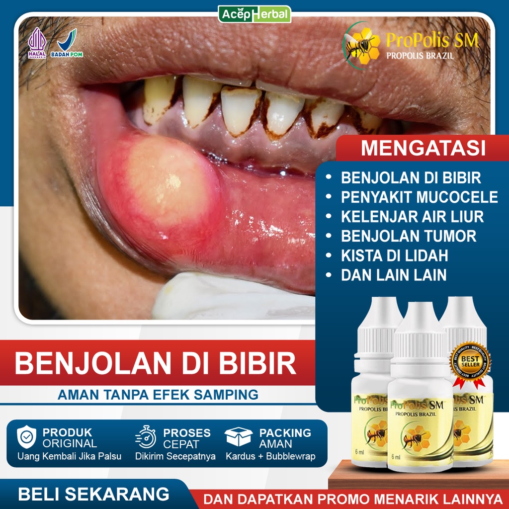 Medicine For Bumps On The Lips Of The Mouth Tongue Mucocele Bumps In ...