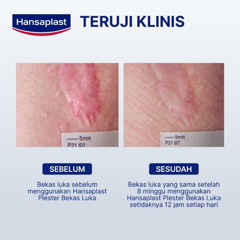 Hansaplast Unit Keloid/Scar Plaster Shopee Malaysia