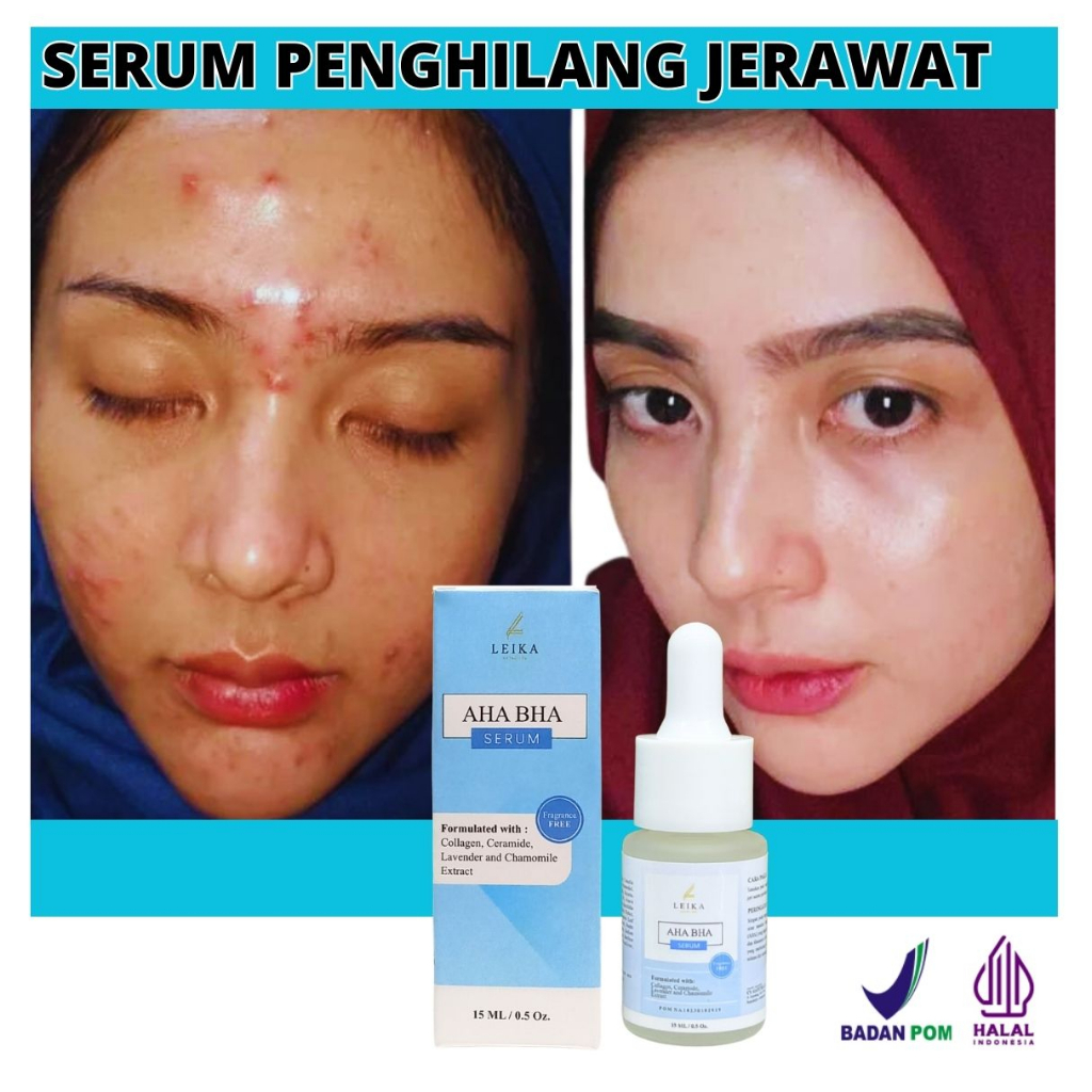 Serum AHA BHA Permanent acne Scar Removal Bpom Most Effective Removing ...