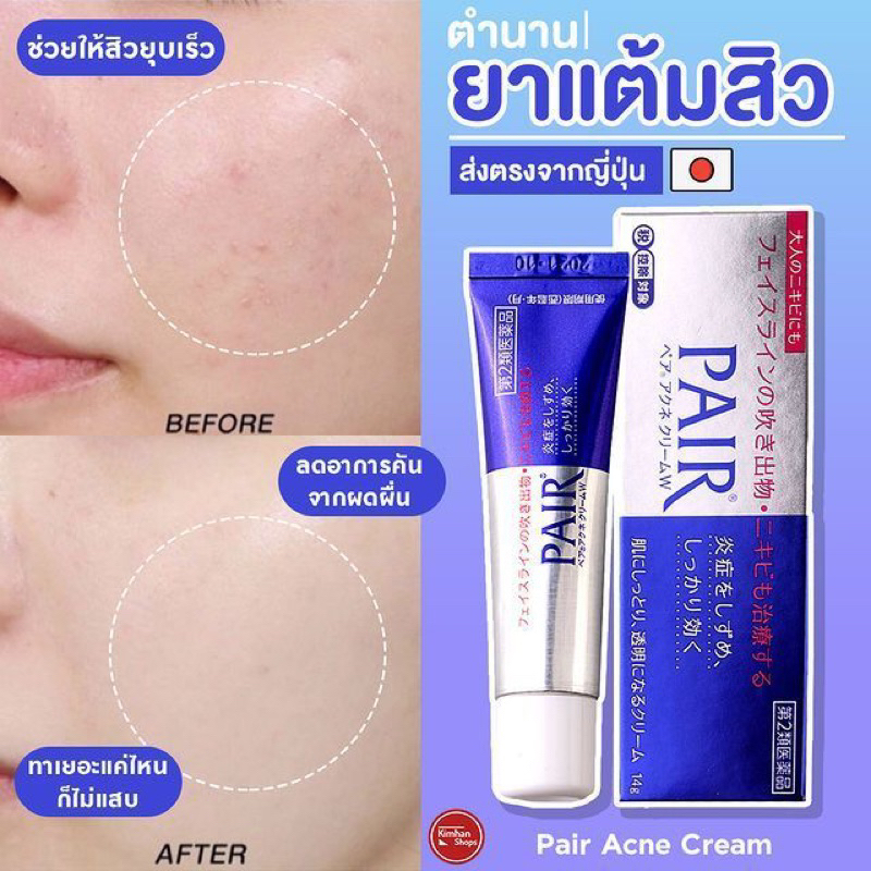 Acne CREAM ACNE Remover ORI JAPAN Shopee Malaysia