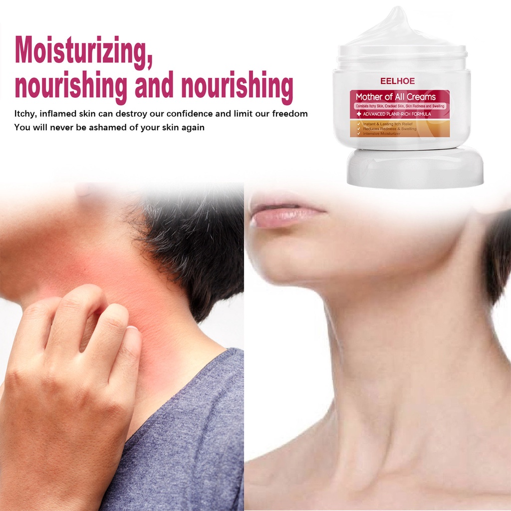 50g Itchy Skin Cream Antiitch Cream Dry Skin Care Hydrating Cream