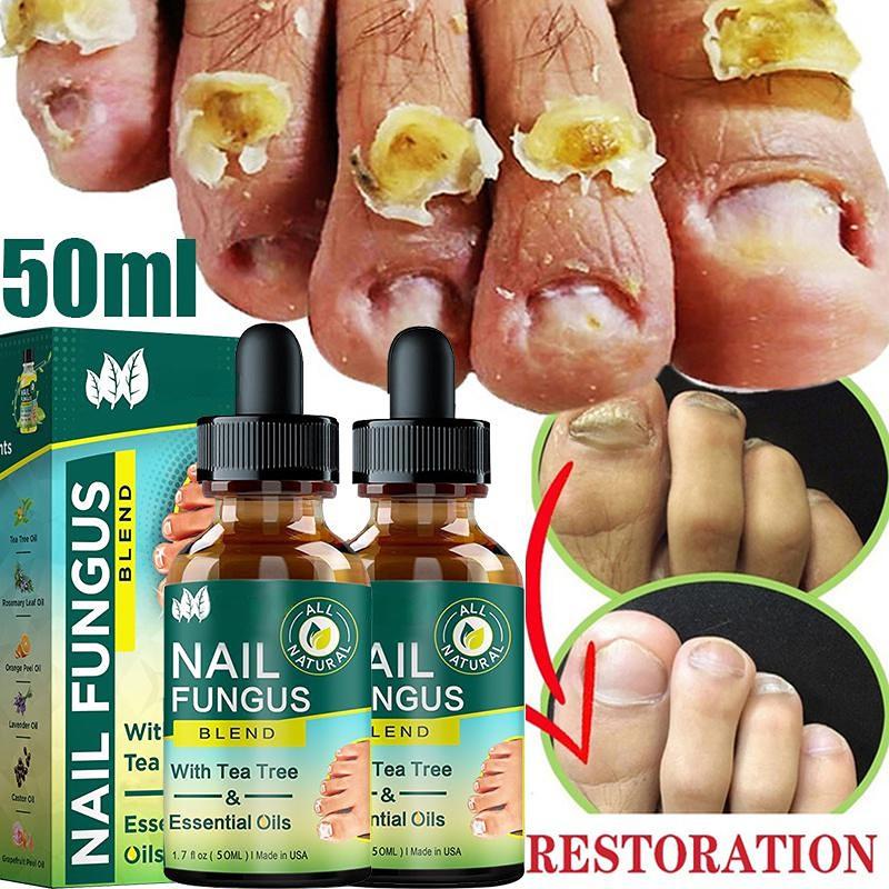 SMTRemove Fungus Nail Repair Essence Essential Oils Serum Nail Fungal