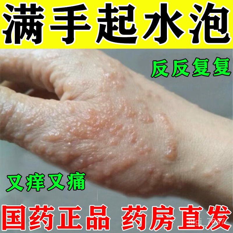 q-sweat-herpes-ointment-small-blisters-on-hands-itching-red-swelling