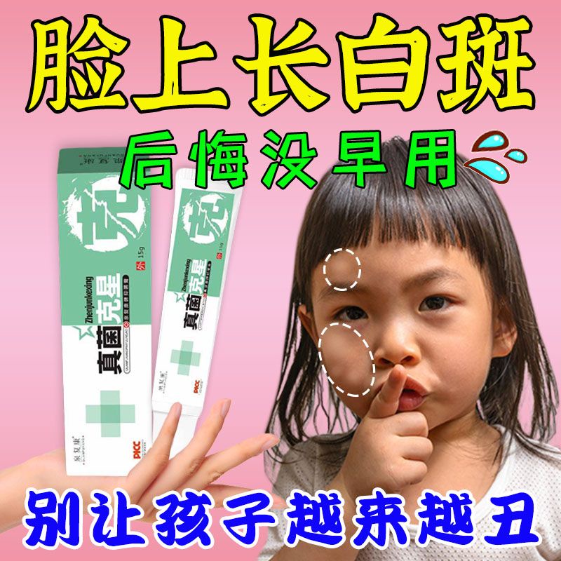 white-spots-on-the-face-of-children-with-pityriasis-alba-dr-white