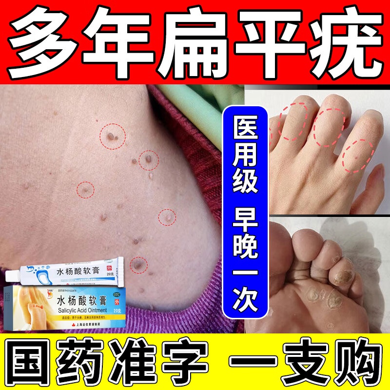 KYJD Salicylic acid ointment Flat Wart Special Plaster Chinese