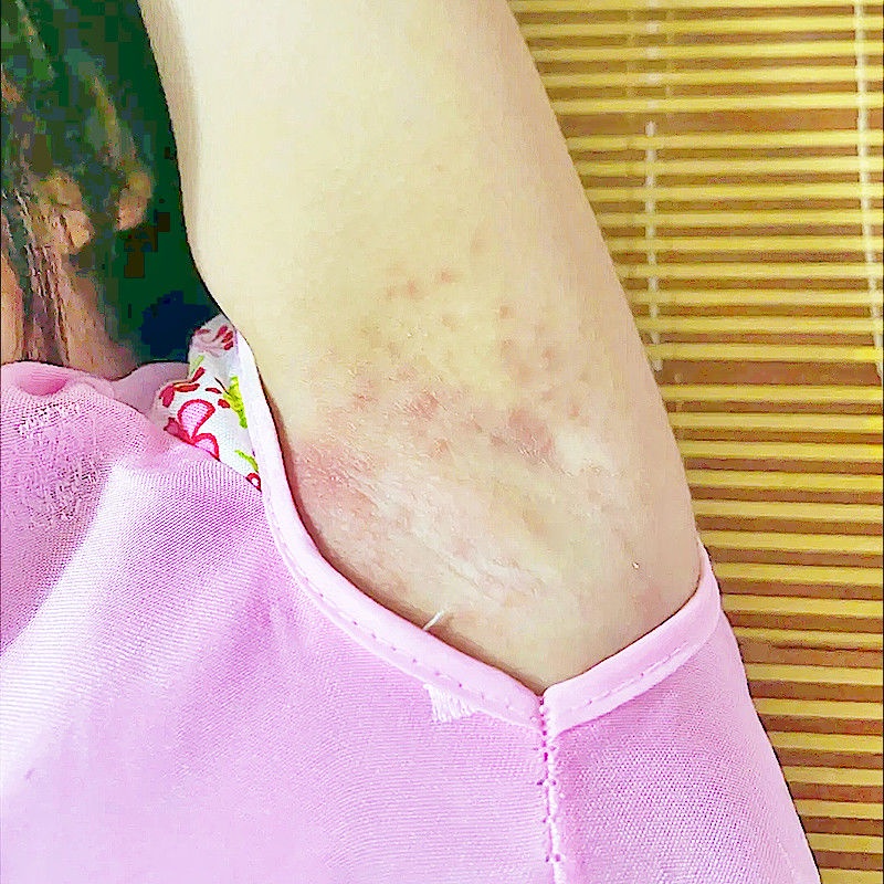 Armpit eczema, creaking, itchy red rash, small pimples in the ar Armpit