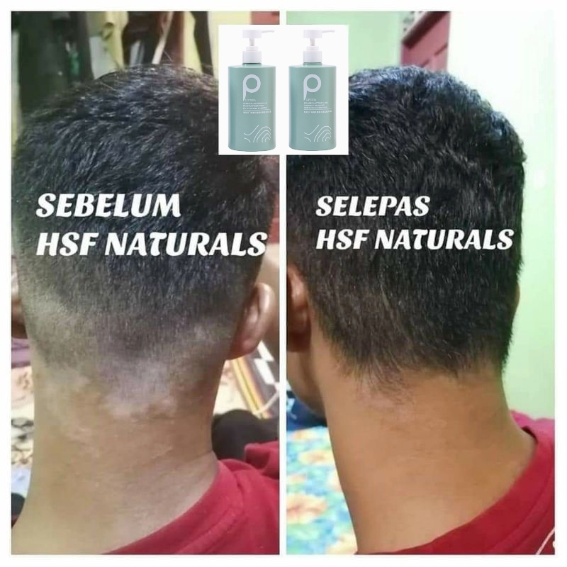 Shampoo Kelemumur Ubat Kelemumur Kepala Syampoo Kelemumur Anti Dandruff