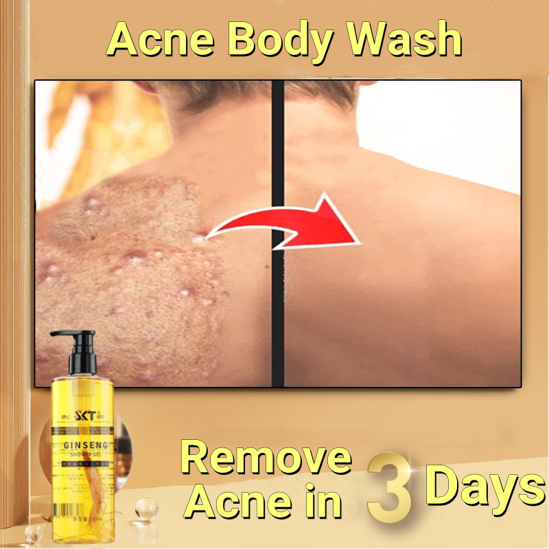 Acne body wash Anti Mite sabun jerawat badan Muka Eczema Kulit Gatal