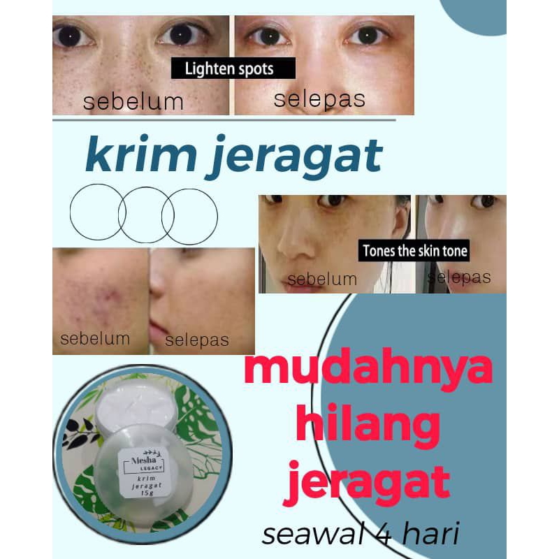 💥💥💥krim jeragat,krim hilangkan jeragat baru,jeragat lama,parut lama ...