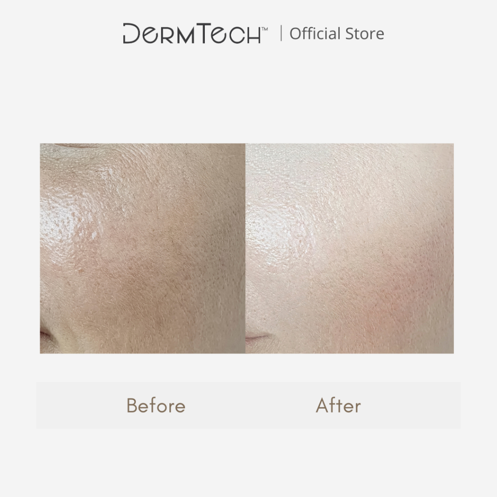 DermTech Treatment Essence (120ml) | Shopee Malaysia