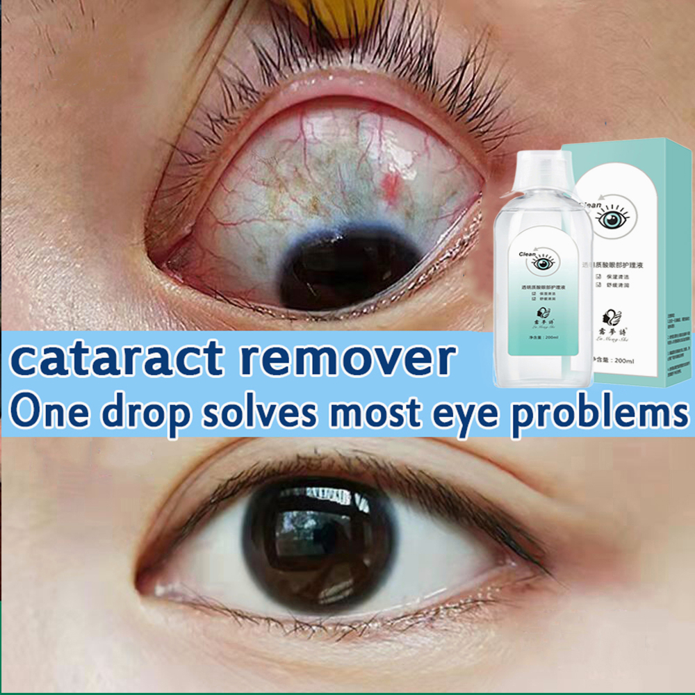 Eye Drops for cataract Medical ubat mata rabun Eye Wash dry eyes drops
