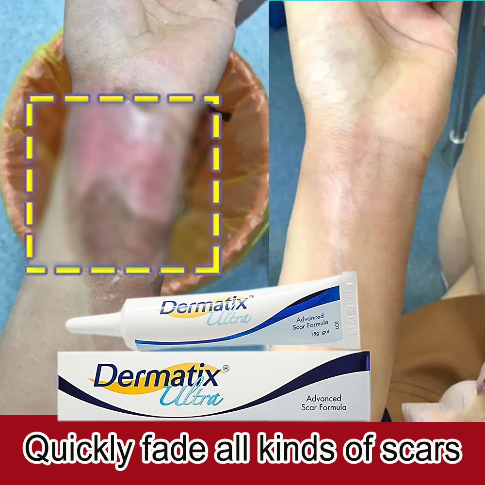 Original dermatix ultra 15g Scar Removal Cream acne scar advance gel ...