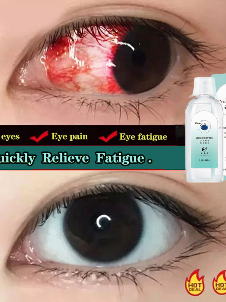 Eye Drops for cataract Medical Eye Wash dry eyes drops ubat mata rabun