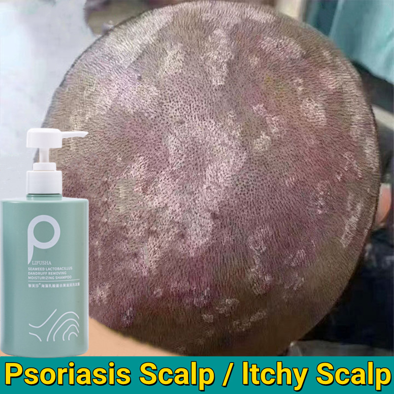 Shampoo Kelemumur Anti Dandruff Shampoo Rambut Masalah Kulit Kepala